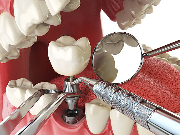 Best Broken or Chipped Tooth Repair in National Park, NJ